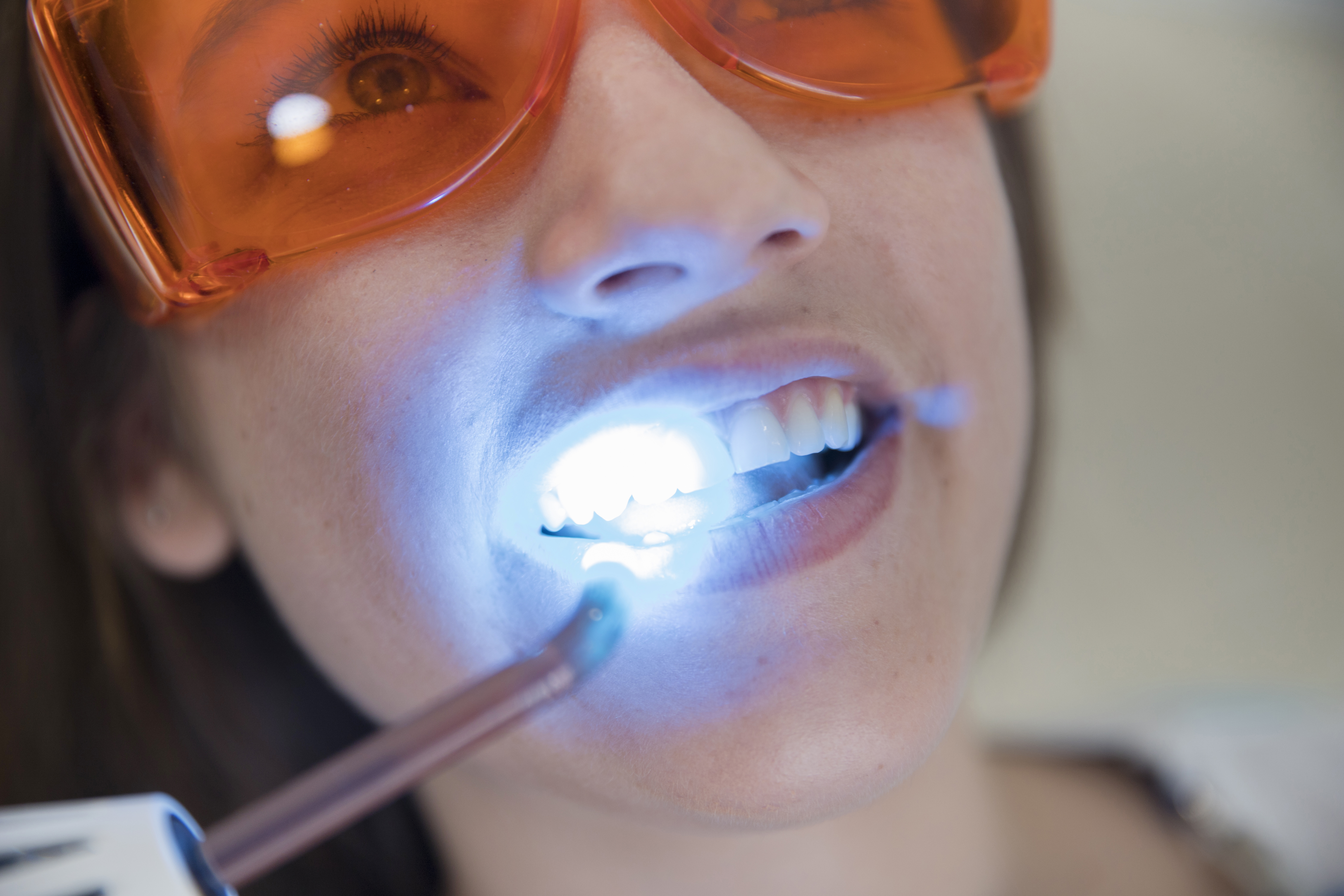 blanqueamiento dental profesional