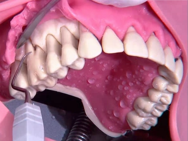 cirugia-periodontal