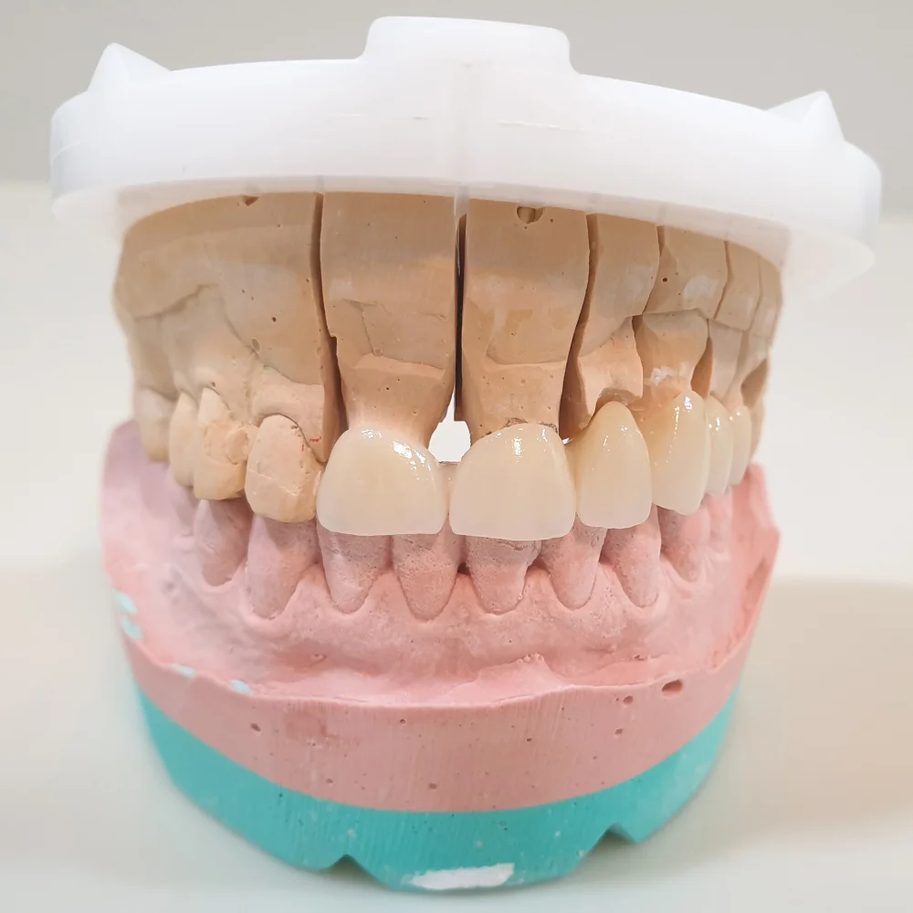 Protesis dental dentosoportada Pontevedra