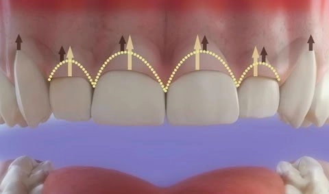 Gingivectomía